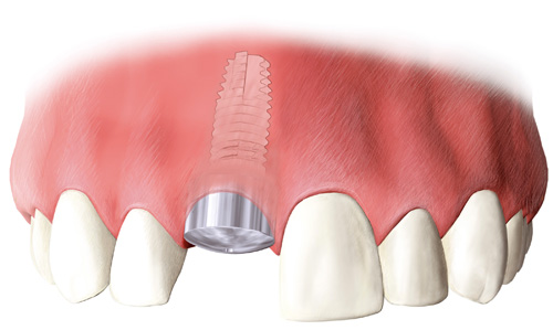 Nach Ende der Einheilung wird auf das Implantat ein so genannter Gingivaformer geschraubt. Die Mundschleimhaut legt sich innerhalb kurzer Zeit um diesen Formkörper herum und bietet der später eingesetzten Implantatkrone ein natürliches Durchtrittsprofil durch die Schleimhaut.