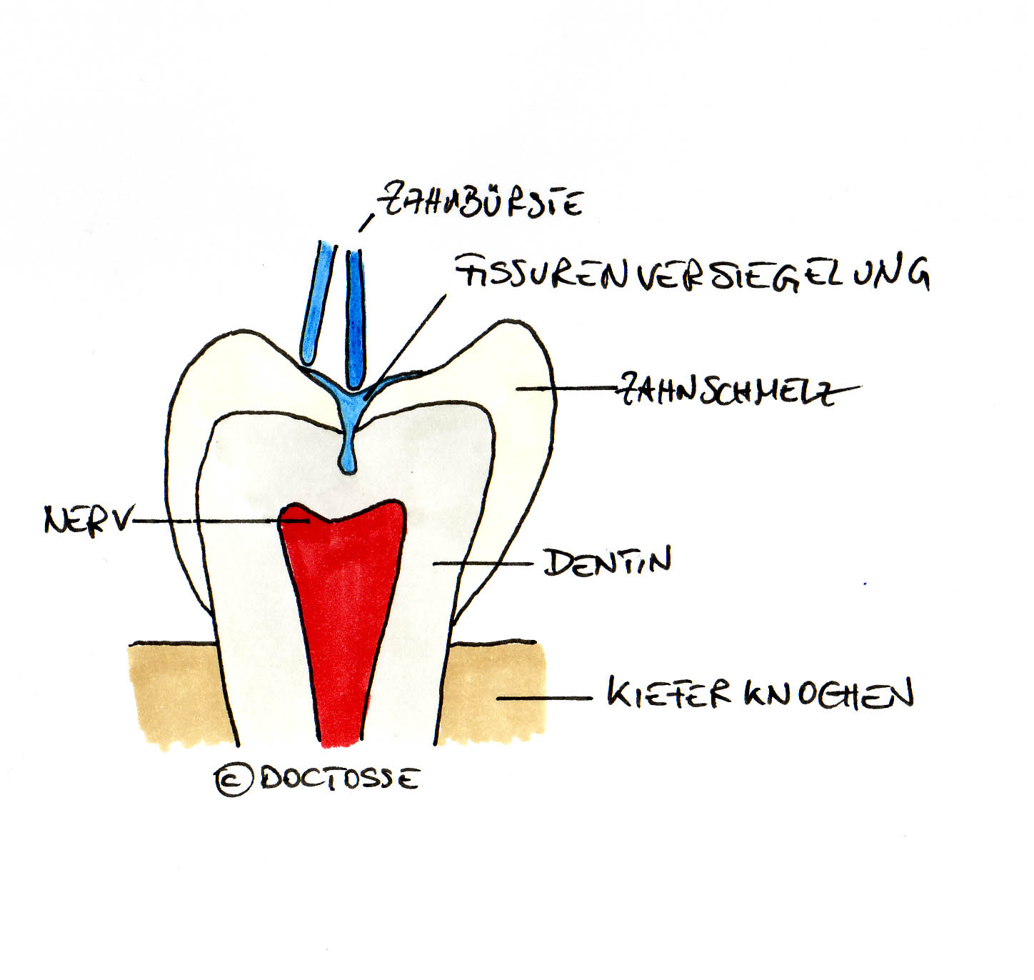 Zeichnung von Dr. Tosse, Fissur mit Versiegelung Zeichnung von Dr. Tosse, Fissur mit Versiegelung