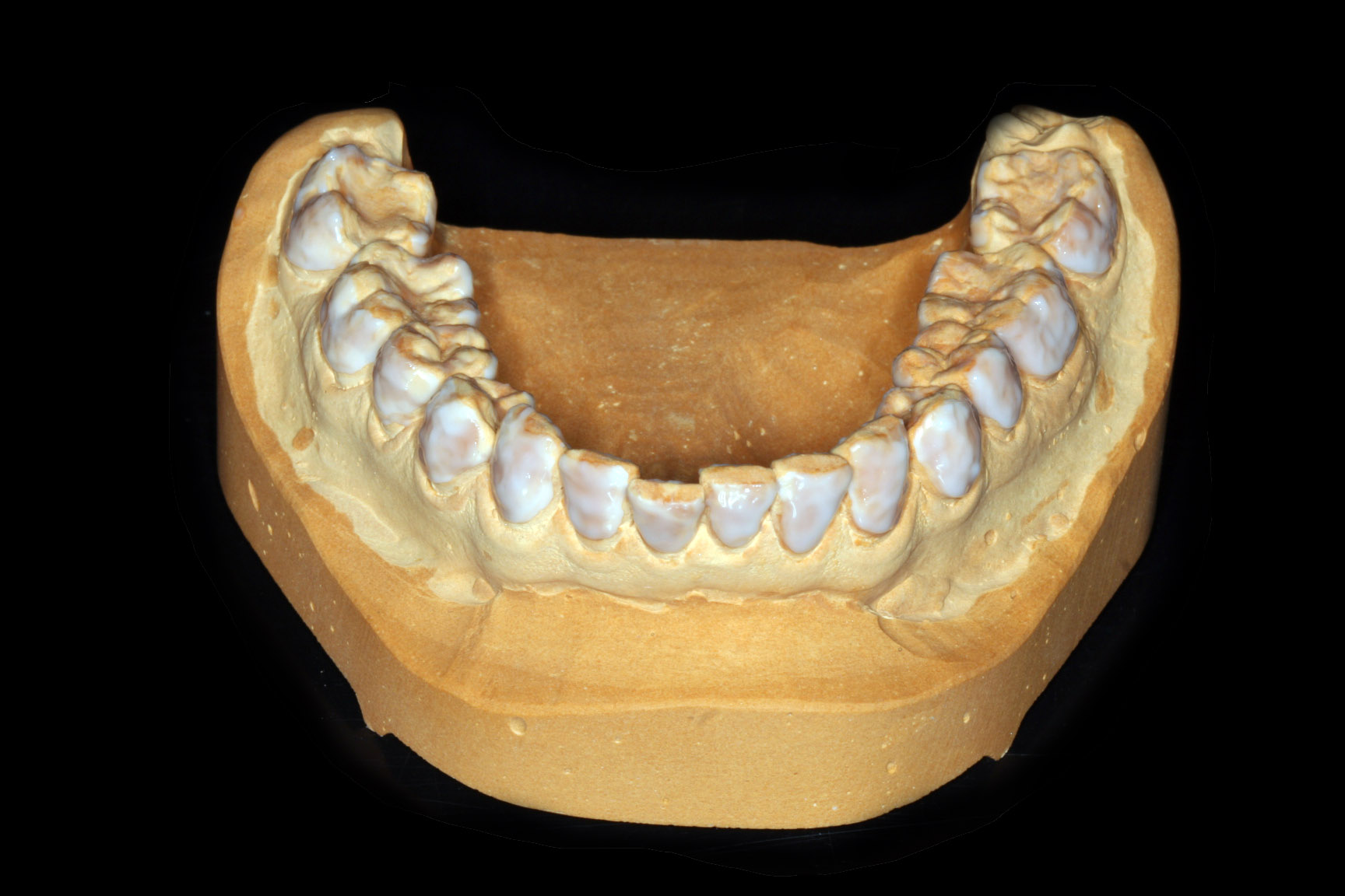 Unterkiefer mit vorbereiteten Zahnflächen