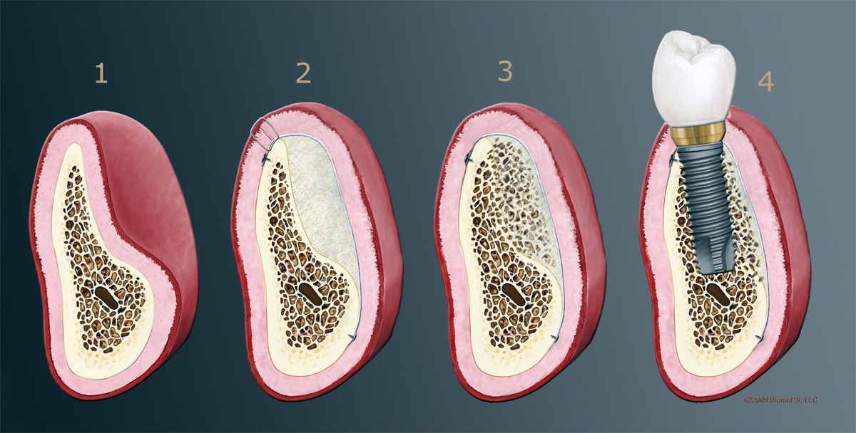 Vorgang des Knochenaufbaus in 4 Schritten