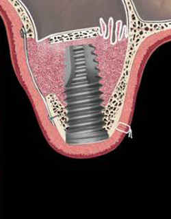 Das Implantat ist eingesetzt. Das Aufbaumaterial ist in einem neu geschaffenen Volumen um das Implantat platziert.